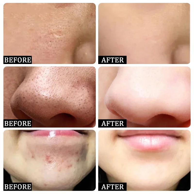 Salicylic Acid Pore Clearing C - đánh giá và giá Salicylic Acid Blackhead Remover
