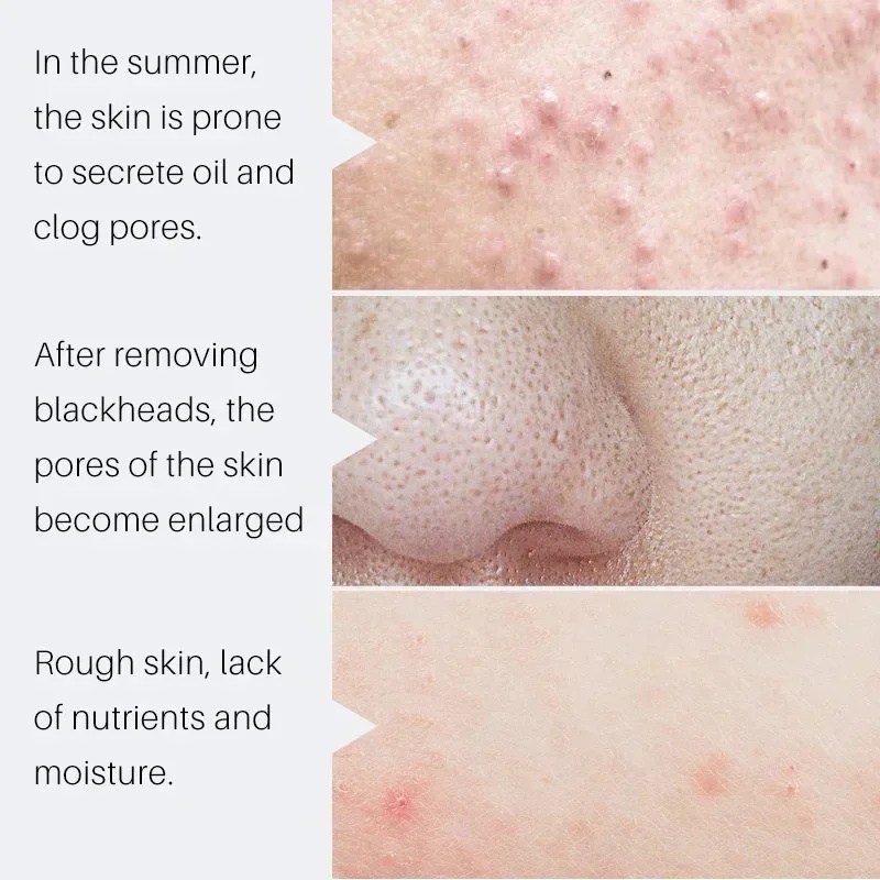 Salicylic Acid Pore Shrinking  - đánh giá và giá Salicylic Acid Blackhead Remover