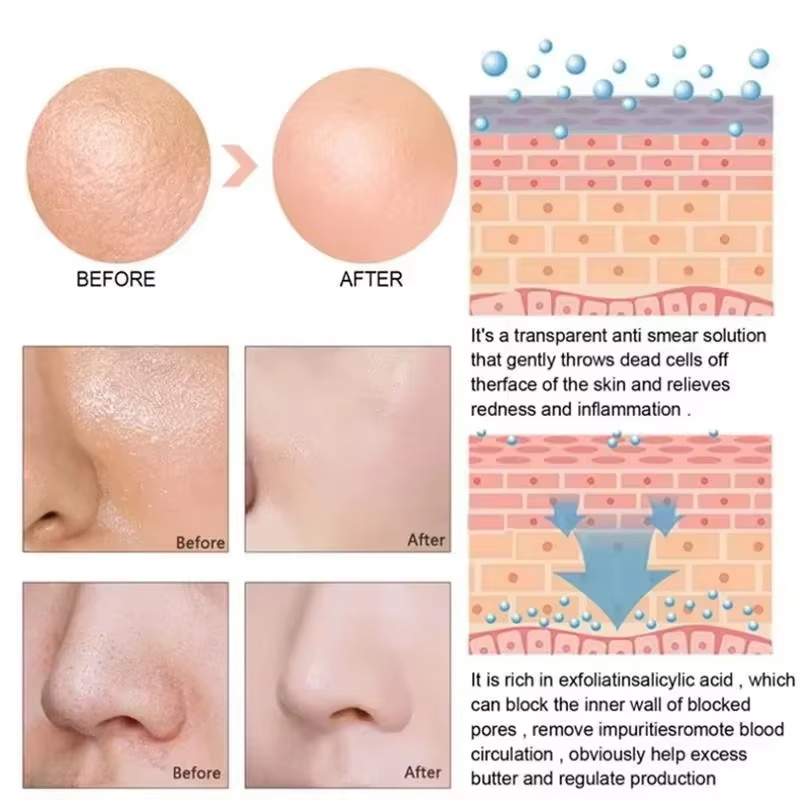 Salicylic Acid Pore Shrinking  - đánh giá và giá Salicylic Acid Blackhead Remover