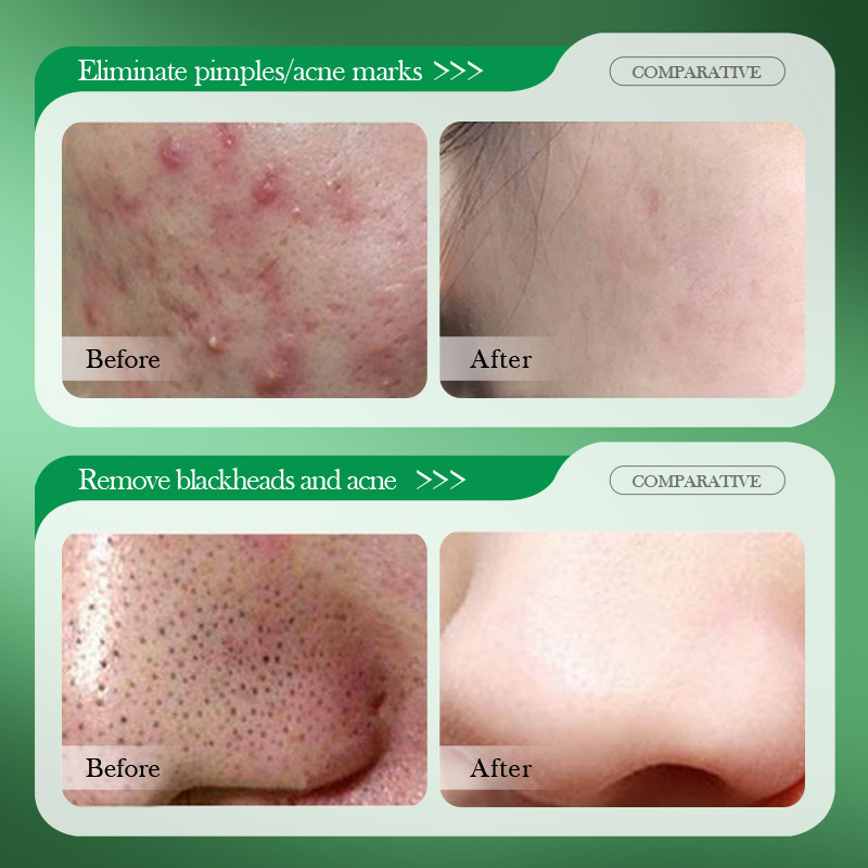 Salicylic Acid Acne Treatment  - đánh giá và giá Salicylic Acid Blackhead Remover